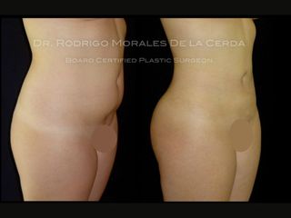 Antes y despues de abdominoplastia