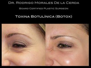 Antes y después de toxina botulínica