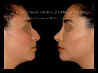 Antes y después de rinoplastia