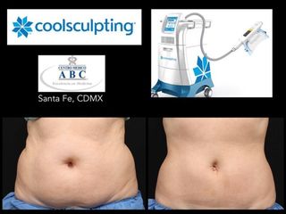 Antes y después de Coolsculpting