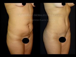 Antes y después de abdominoplastía