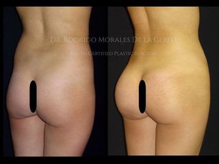 Antes y después de gluteoplastía con implantes