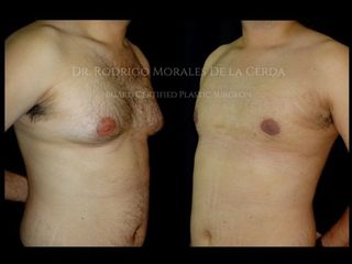 Antes y después de lipo ginecomastia