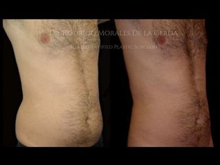 Antes y después de lipoescultura 