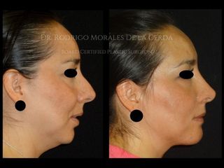 Antes y después de liposucción de papada