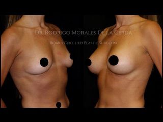 Antes y después de Mamoplastía de aumento