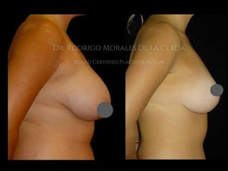 Antes y después de Reducción de mamas