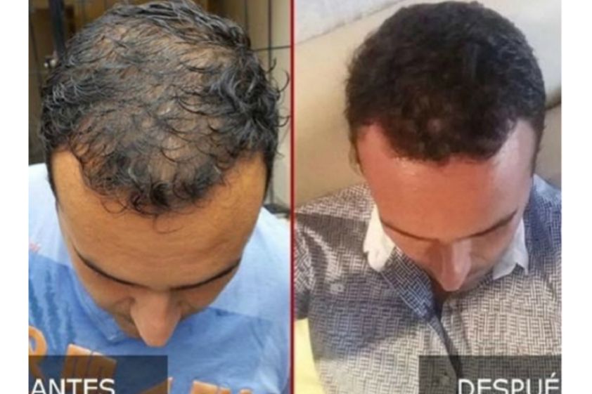 Trasplante de cabello antes y después - 606386