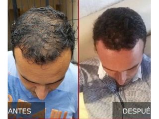 Antes y después de Trasplante de cabello