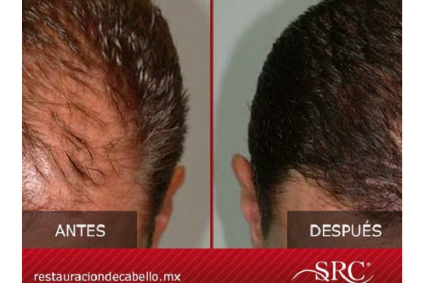Trasplante de cabello antes y después - 606548