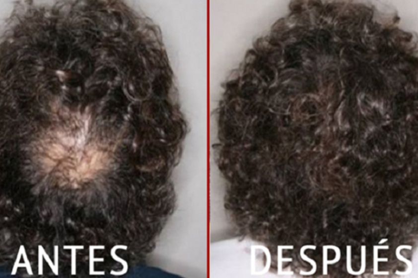 Micropigmentación antes y después - 606553