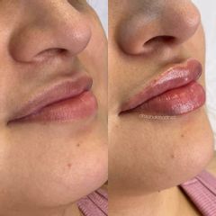 Aumento de labios - Ginecoestetica MTY
