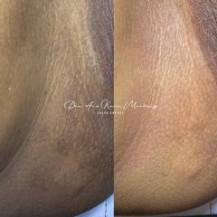 Blanqueamiento anal - Ginecoestetica MTY