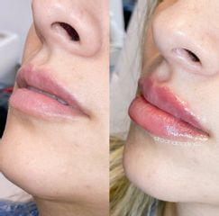 Aumento de labios - Ginecoestetica MTY