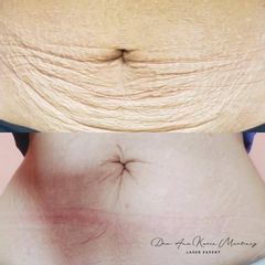 Láser CO2 Fraccionado - Ginecoestetica MTY