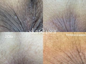 Blanqueamiento anal antes y después - 738115