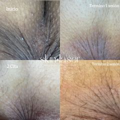 Blanqueamiento anal - Ginecoestetica MTY