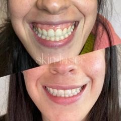 Sonrisa gingival - Ginecoestetica MTY