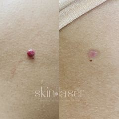 Nevo Rubi ó Hemangiomas - Ginecoestetica MTY