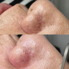 Telangiectasias ó arañas vasculares - Ginecoestetica MTY