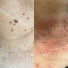 Fibromas en cuello - Ginecoestetica MTY