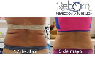 Antes y después de Radiofrecuencia