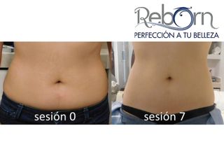 Antes y después de Cavitación