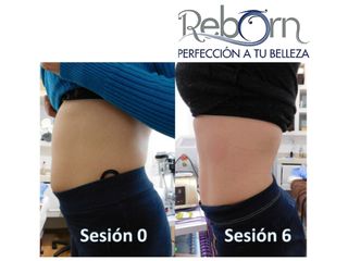 Antes y después de Lipoláser
