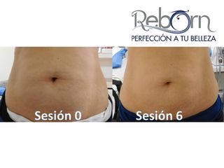 Antes y después de Cavitación y radiofrecuencia