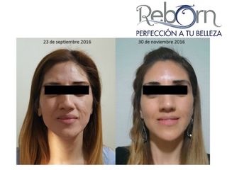 Antes y después de Rejuvenecimiento facial