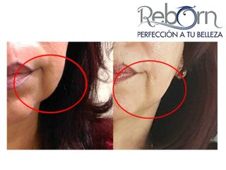 Antes y después de Rejuvenecimiento facial