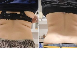 Antes y después de Lipoescultura