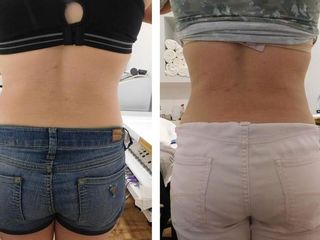 Antes y después de tratamiento reductor