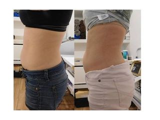 Antes y después de tratamiento reductor