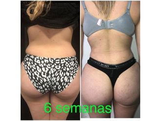 Liposucción antes y después - 699511