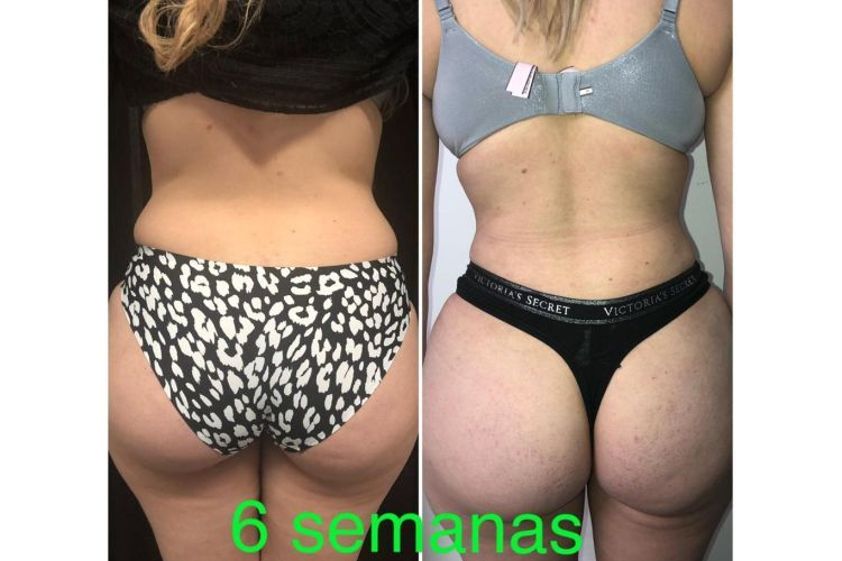 Liposucción antes y después - 699511