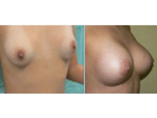 Antes y después de Aumento de busto