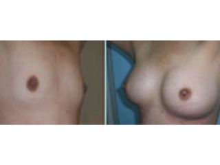 Antes y después de Aumento de busto