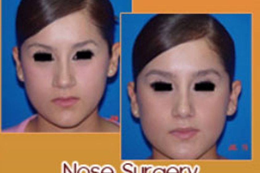 Rinoplastia antes y después - 204797