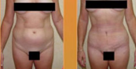 Antes y después de liposucción