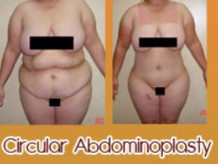 Antes y después de abdominoplastia 