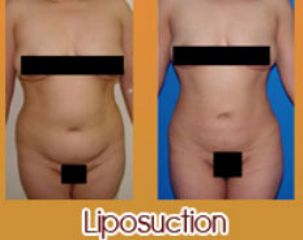 Antes y después de liposucción