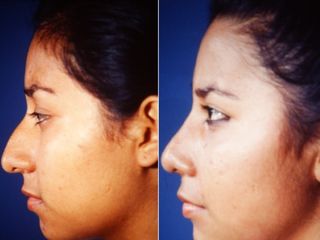 Antes y después de Rinoplastia