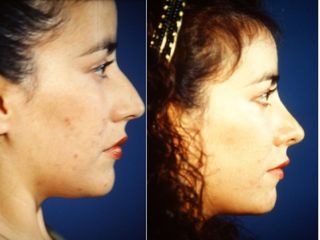 Antes y después de Rinoplastia