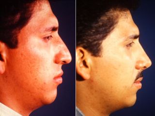 Antes y después de Rinoplastia