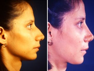 Antes y después de Rinoplastia