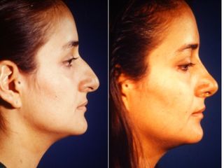 Antes y después de Rinoplastia