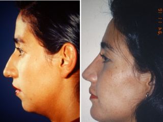 Antes y después de Rinoplastia