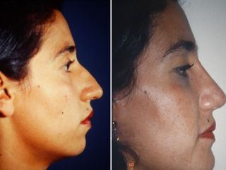 Antes y después de Rinoplastia