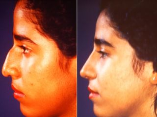 Antes y después de Rinoplastia